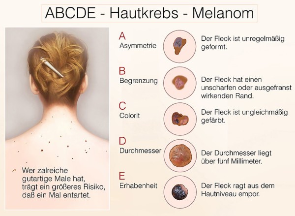 Hautkrebs: Ursachen - Symptome | Hautarztzentrum Kiel