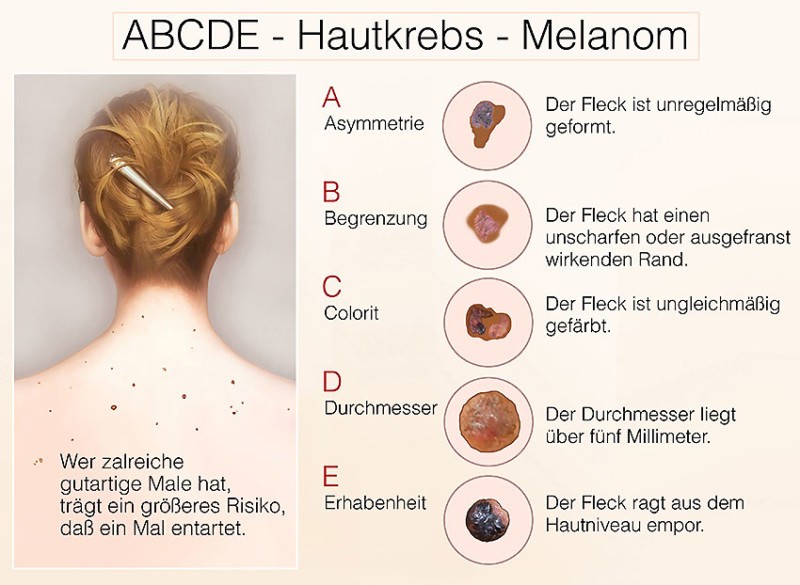 Hautkrebs: Ursachen - Symptome | Hautarztzentrum Kiel